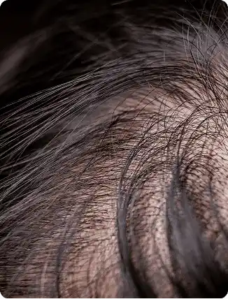 Thinning